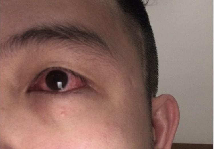 F0 bị đỏ mắt, bác sĩ cảnh báo 'triệu chứng không thể chủ quan' 